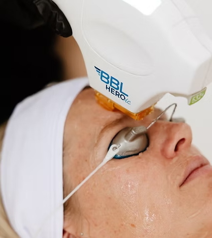 bbl-treatment